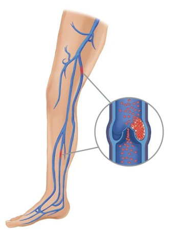 The cause of the appearance of varicose veins