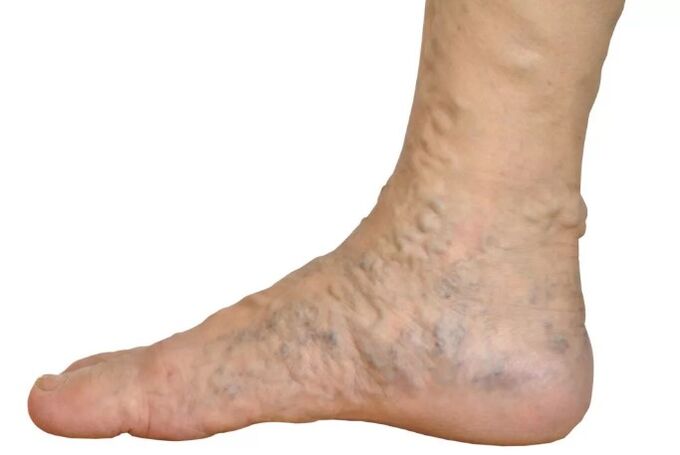 The diseases of the walking veen