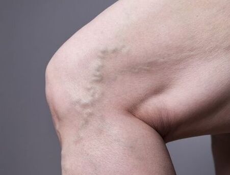 Varicose veins