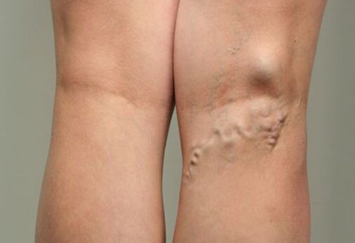 Vein