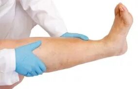 Swelling of the lower limbs