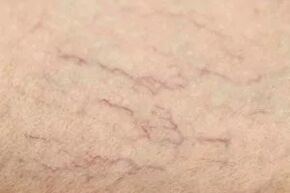 Vascular stars