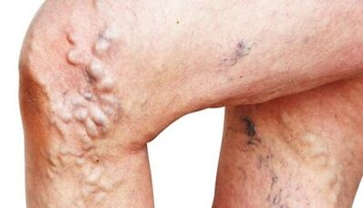 The main manifestations of varicose veins in the legs