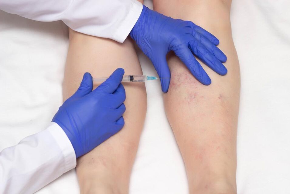 Sclerotherapy is a method for treating varicose veins