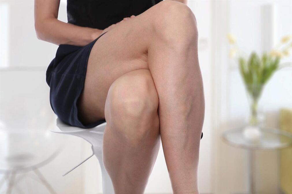Varicose veins in a woman