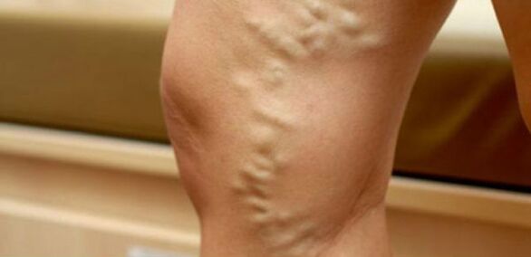 varicose veins in women's legs