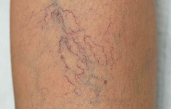 varicose veins on legs in women