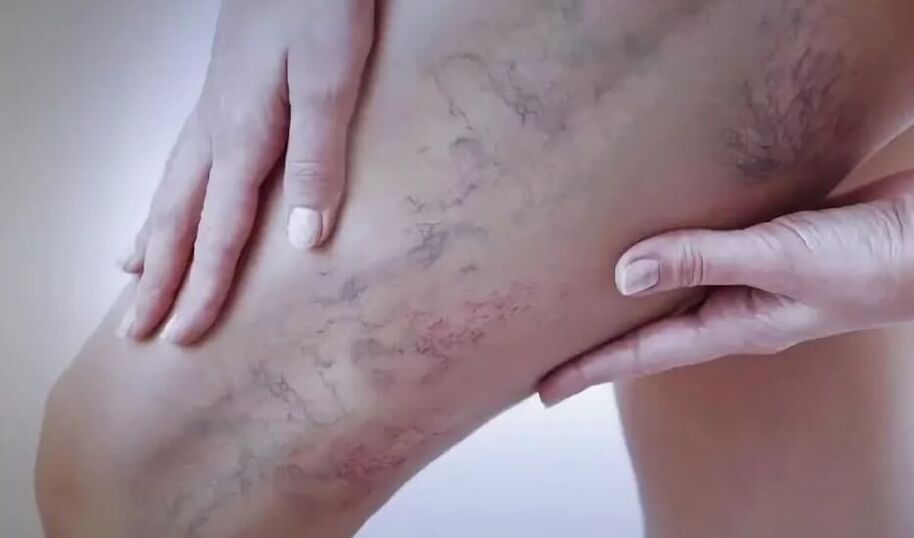 The standing stars with varicose veins