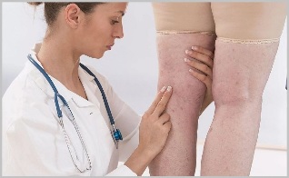 One woman consulted a doctor with clear signs of varicose veins