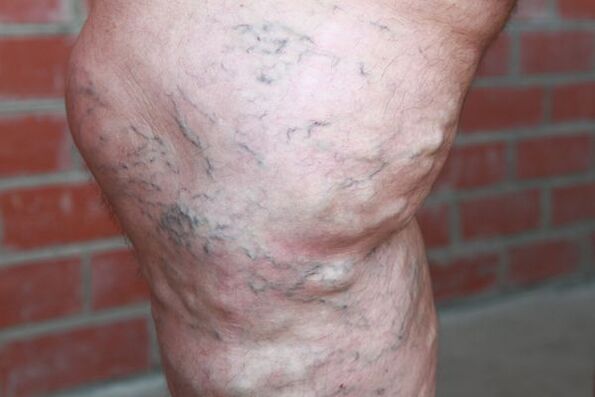 Varicose vein signs