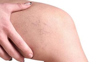 stages of development of varicose veins