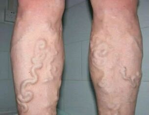 Varicose veins of grade 3 in the leg