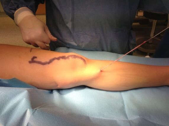 removal of veins with varicose veins