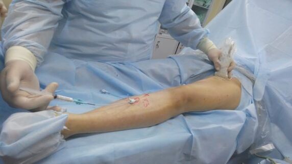 surgery for varicose veins in the legs