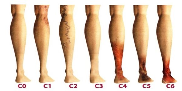 stages of varicose veins in the legs