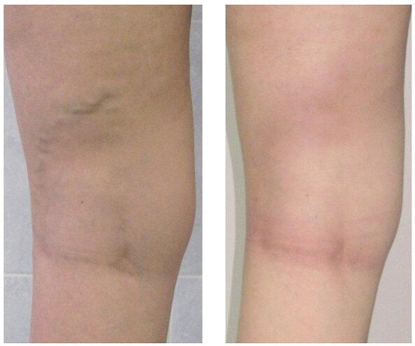 veins in the legs before and after treatment of varicose veins