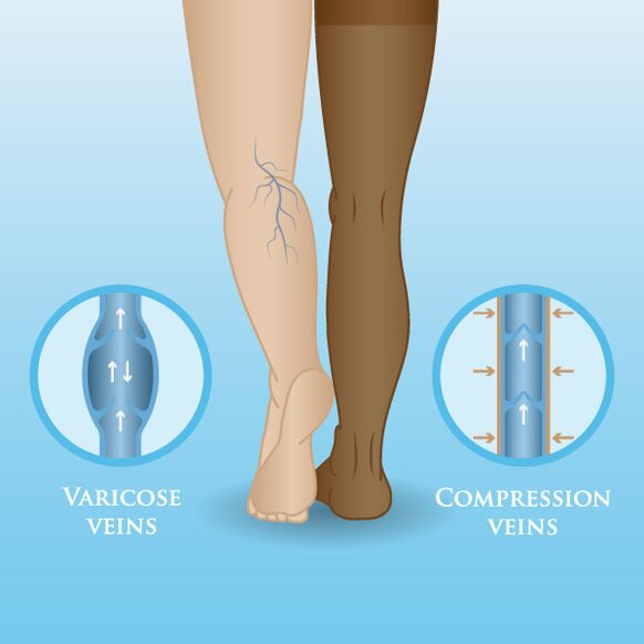Effects of compression dressings on varicose veins in the legs