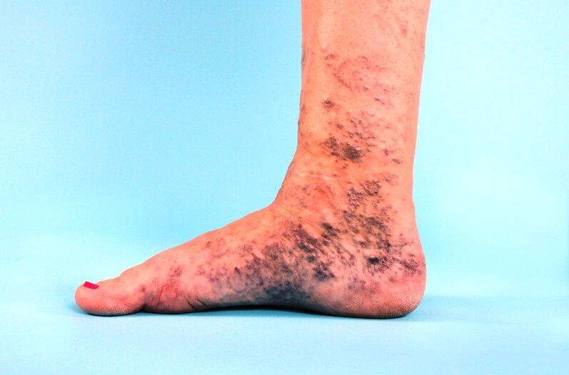 varicose veins neglected in the legs