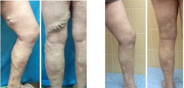 Legs before and after the disappearance of varicose veins with varicose veins