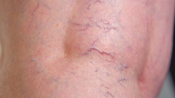 Signs of veins with reticular varicose veins of the lower extremities - dilation of small veins and vascular networks