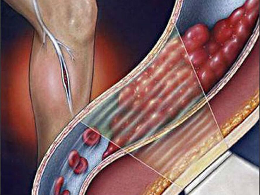 deep vein thrombosis as a complication of varicose veins