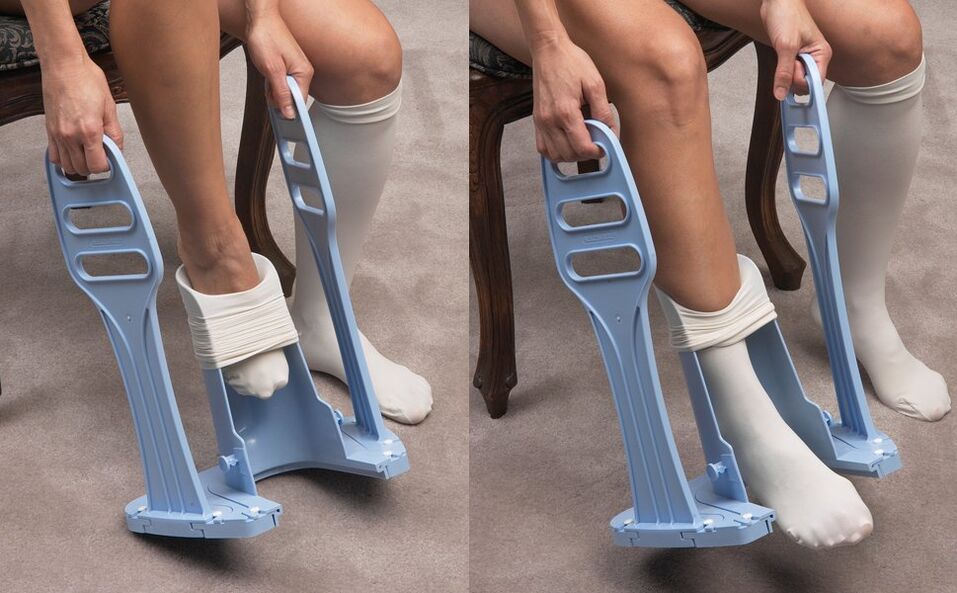 placement of compression stockings for varicose veins