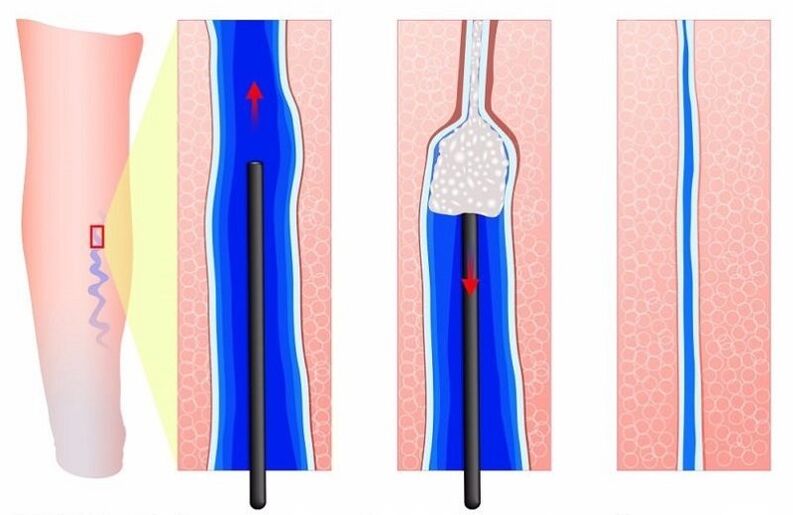 sclerotherapy for varicose veins in men