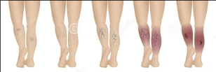 Varicose veins of the lower extremities stage